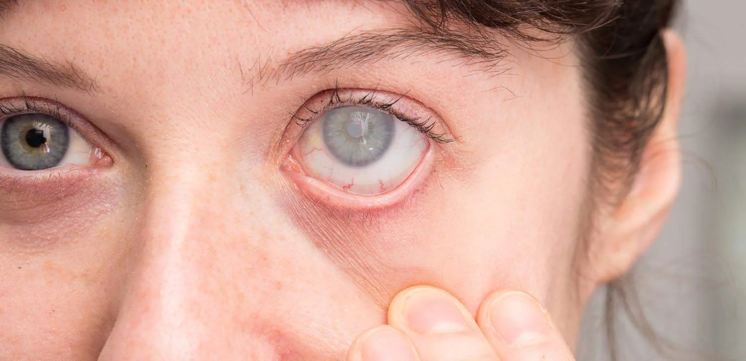 Diabetic Retinopathy